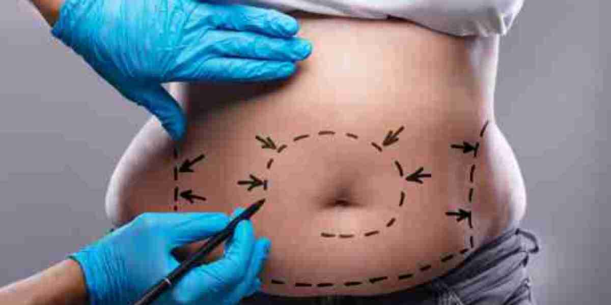 Get the Best Deals on Liposuction in Riyadh
