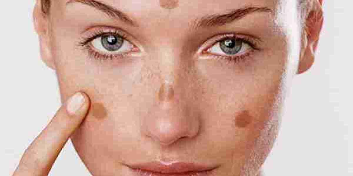 Can Retinol Help with Melasma?