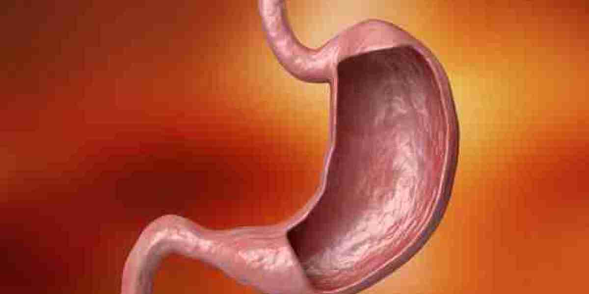 Gastric Balloon for BMI Riyadh Criteria
