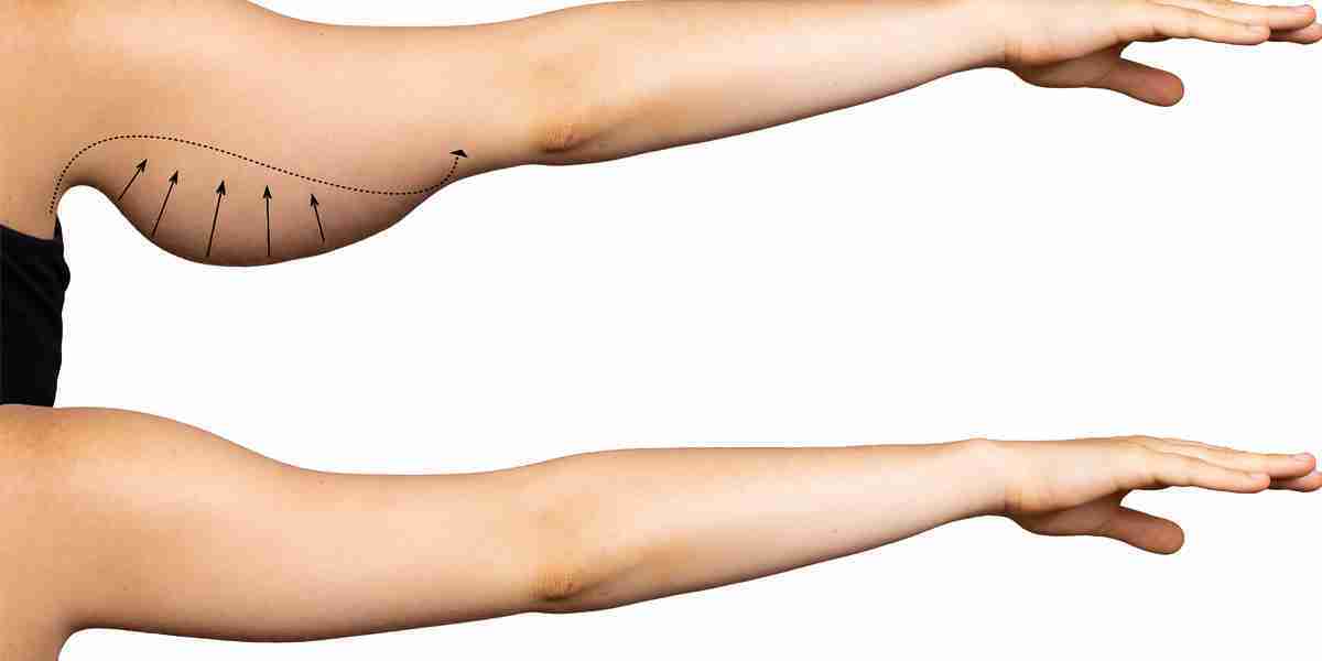 How Loose Skin Arm Surgery in Islamabad Can Transform Your Arms