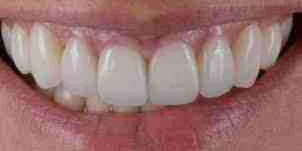 How to Fix a Gummy Smile with Veneers?