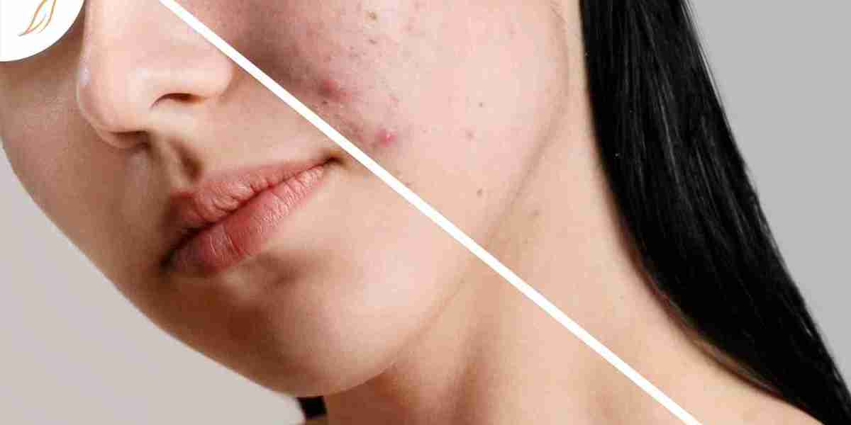 علاج سريع للمسام الواسعة يمكنكِ إجراؤه أسبوعيًا