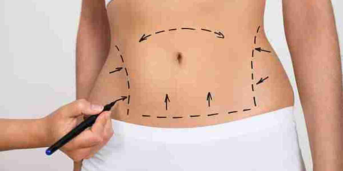 Are There Non-Surgical Liposuction Alternatives in Riyadh?