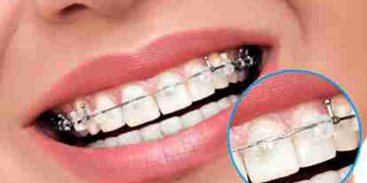 How Often Do I Need to Wear Aligners?