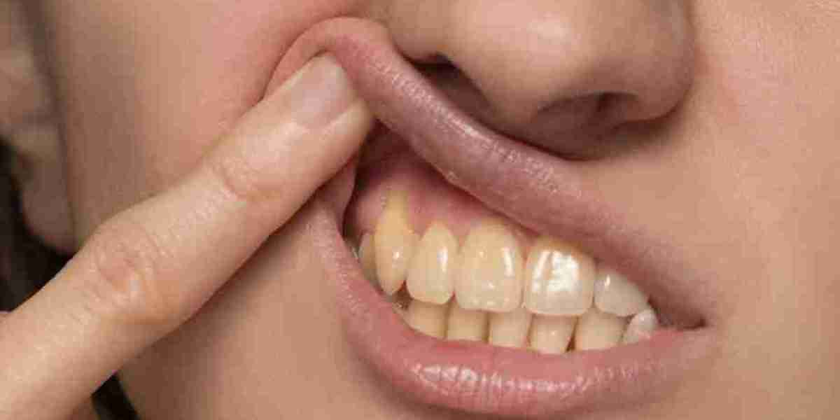 Can Charcoal Really Remove Tooth Stains?