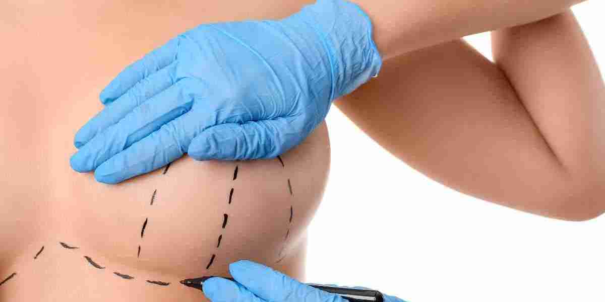 Ideal Candidates for Breast Reduction in Riyadh