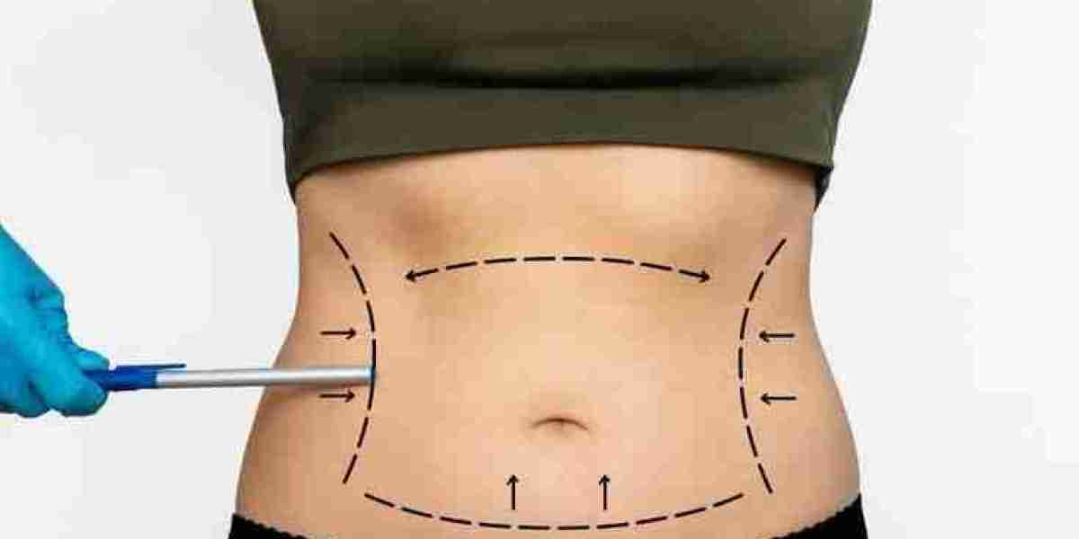 Liposuction Results: Before & After Riyadh