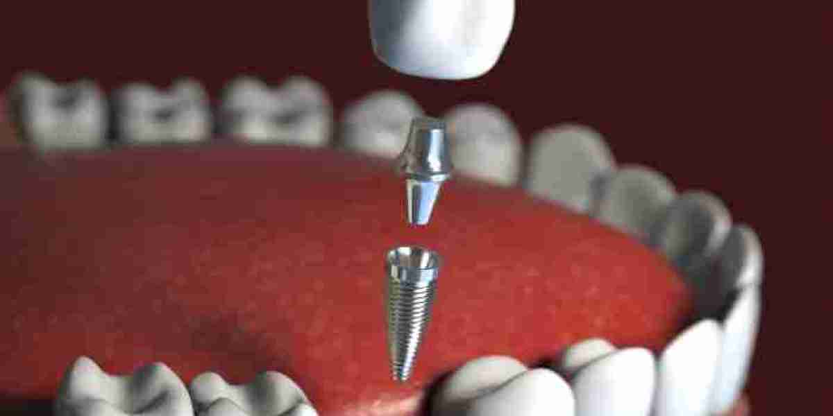 How Do I Know If Same-Day Implants Are Right for Me?