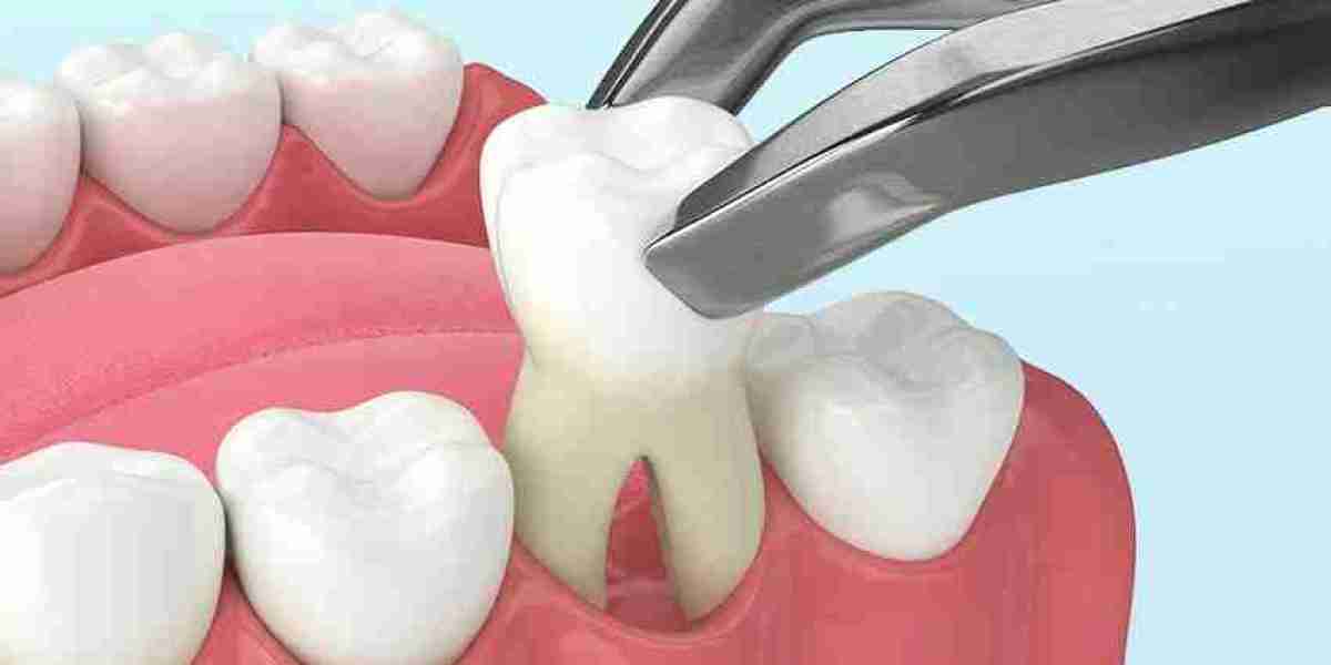 Can a Tooth Be Pulled Without Surgery If I’m on a Budget in Dubai?