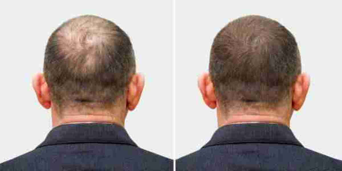 أهمية الاستعداد النفسي قبل خوض تجربة زراعة الشعر