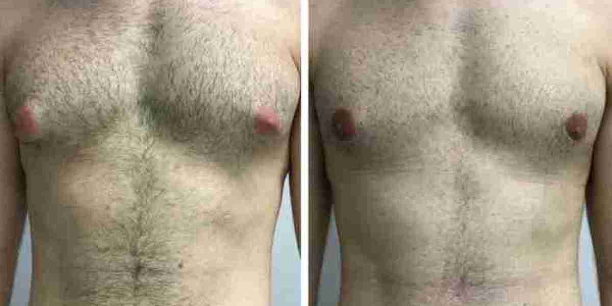 How Medical Tourism Supports Gynecomastia in Dubai
