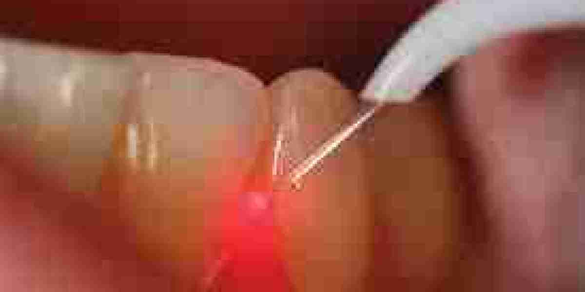 Dental Lasers Market Development: Transforming Modern Dentistry with Precision Technology