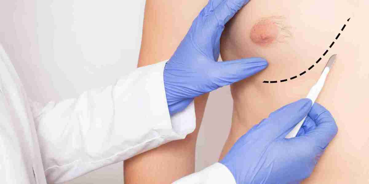 What is Gynecomastia? Causes, Symptoms, and Treatments in Islamabad