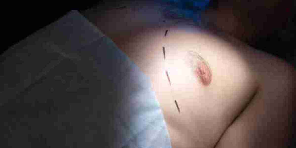 A Man’s Guide to Gynecomastia Surgery in Riyadh