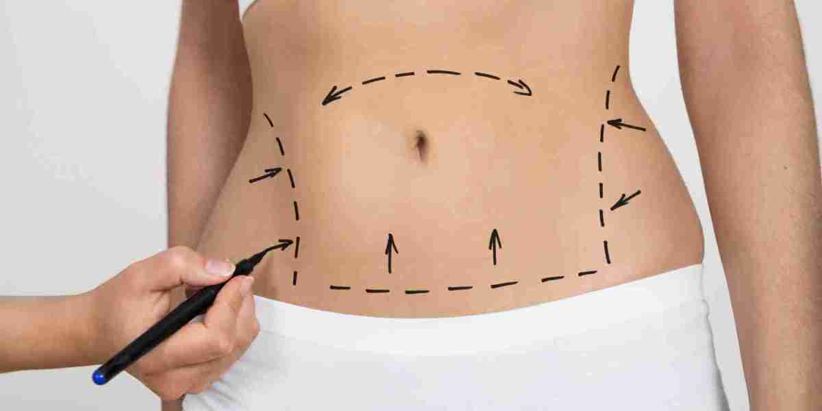 Experience the Power of Laser Liposuction