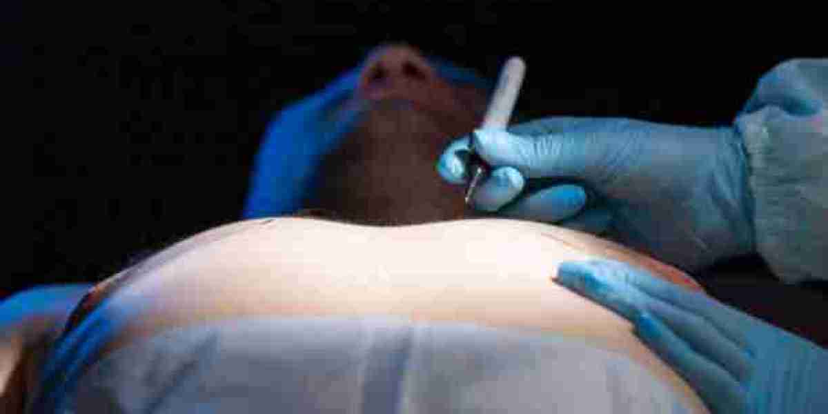 Gynecomastia Surgery in Riyadh: Risks, Benefits, and Long-term Results