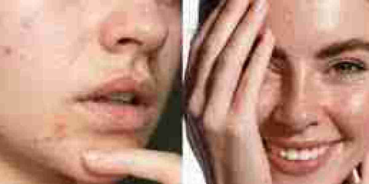 Anti-Acne Cosmetics Market investments surging in natural ingredient-based product lines and development