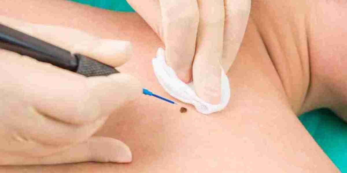 does medicare cover wart removal