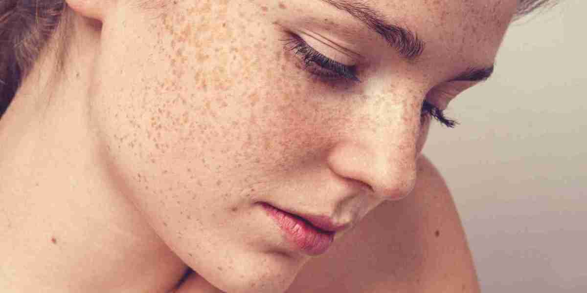 Melasma Treatment: Repair Skin from the Inside