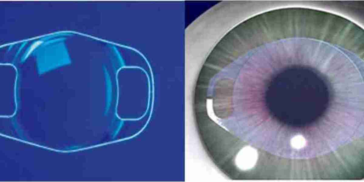 Implantable Collamer Lens Market Rising Demand Fueled by Technology and Vision Health Awareness