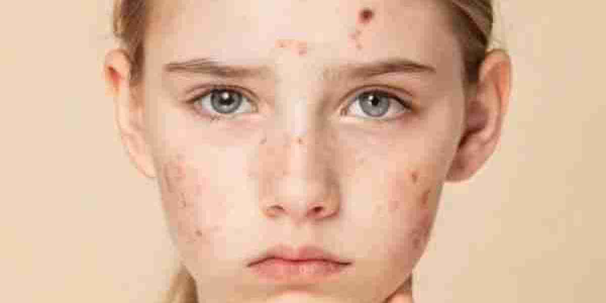 Expert Acne Care Clinics in Riyadh