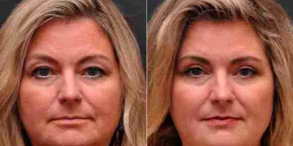 Blepharoplasty In Bangalore