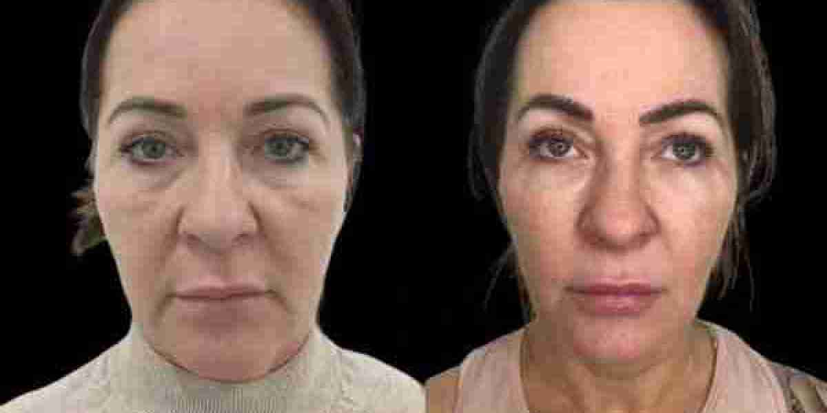 Best Aesthetic Clinics in Dubai Share Profhilo Aftercare Tips