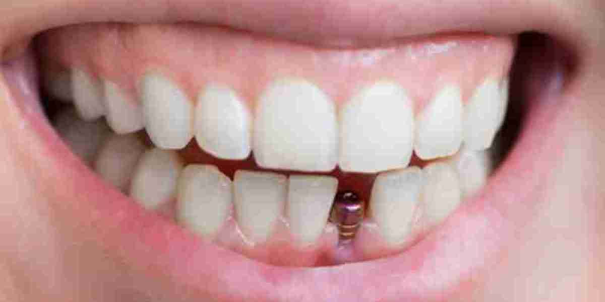 Does a Weak Immune System Affect Implant Health?