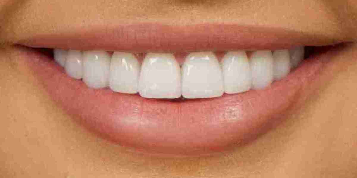 Is There an Age Limit for Getting Non-Prep Veneers?