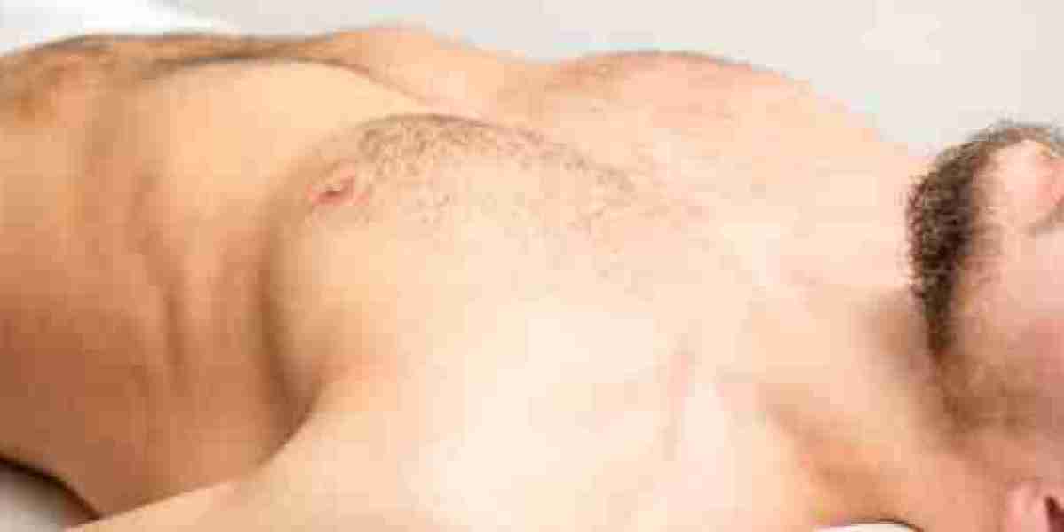 How to Reduce Scarring After Gynecomastia Surgery