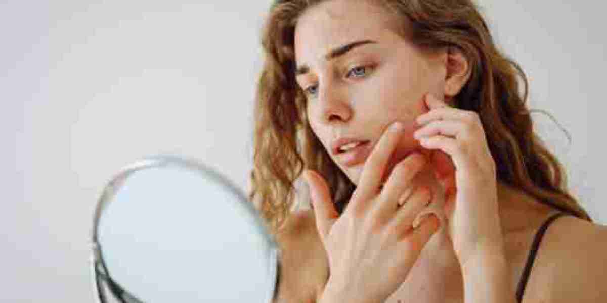 Natural Remedies for Acne in Riyadh