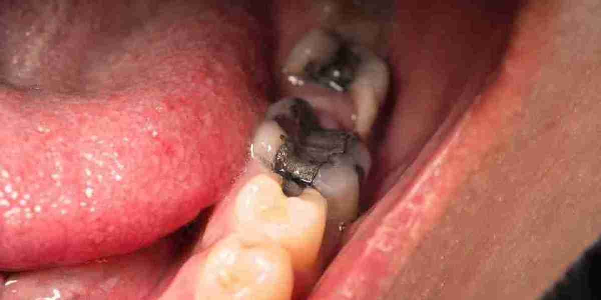 Are White Composite Fillings Safer Than Amalgam?