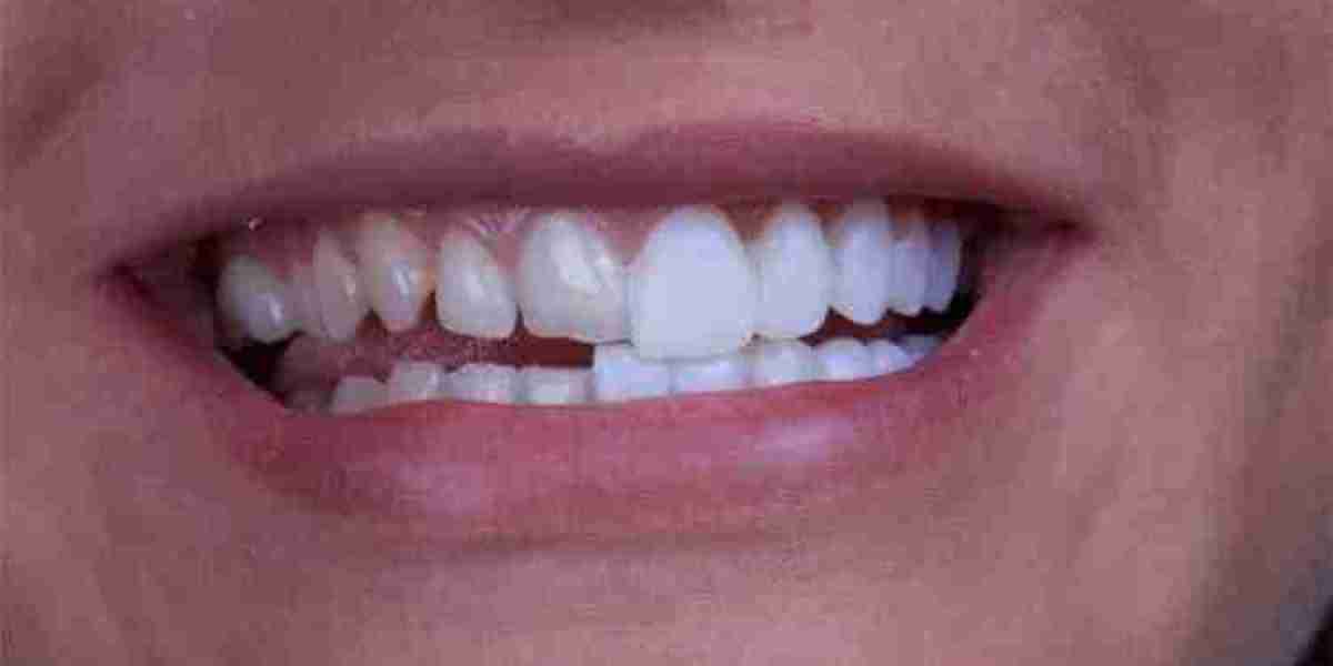 Are Veneers a Good Solution for Gaps?