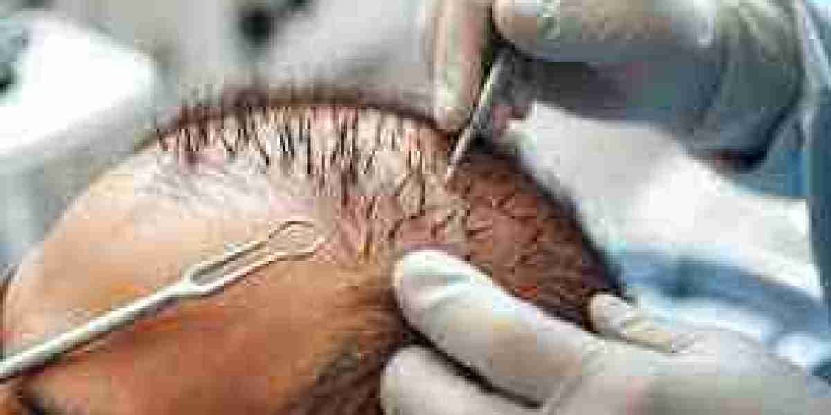 What Do Reviews Say About the 1 Dirham Hair Transplant?