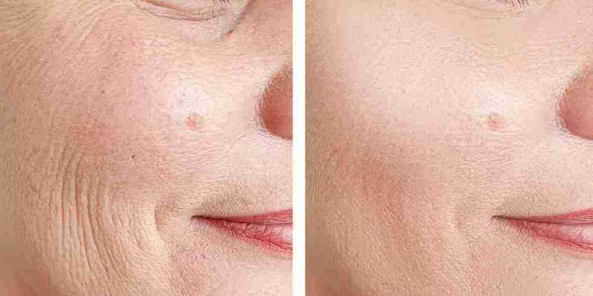 Can Skin Booster Injections Help With Dull Skin?