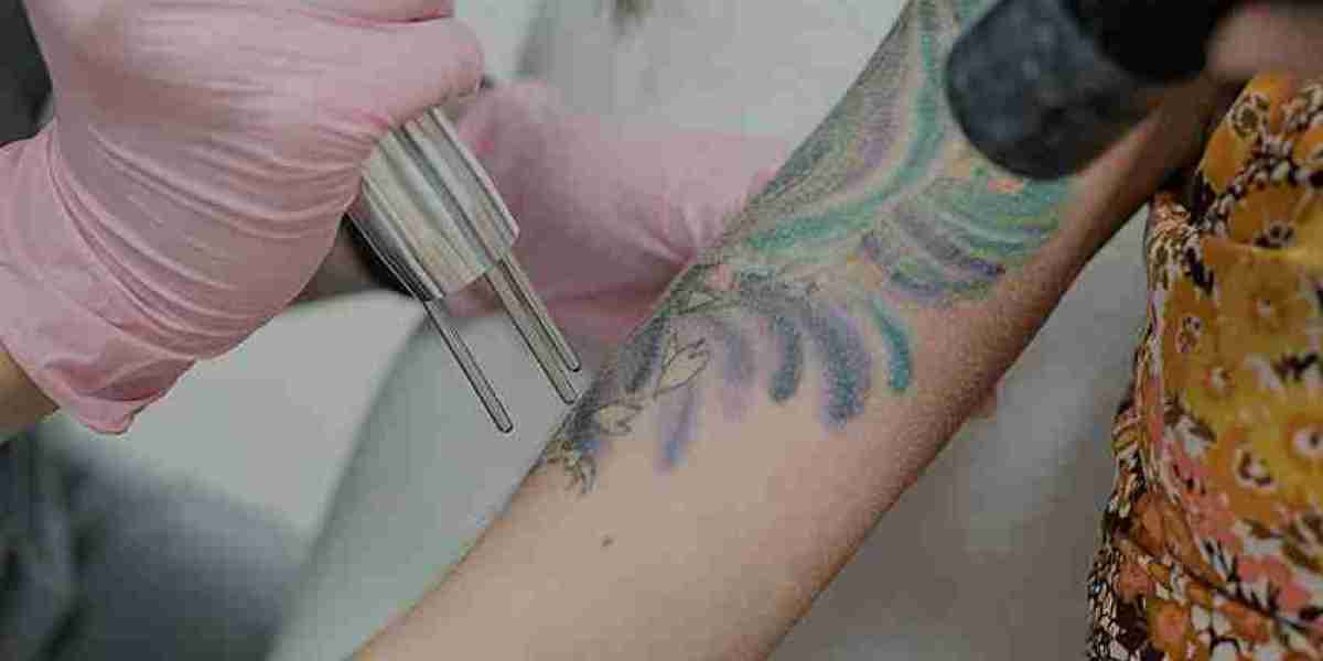 Laser Tattoo Removal: The Science Behind the Ink