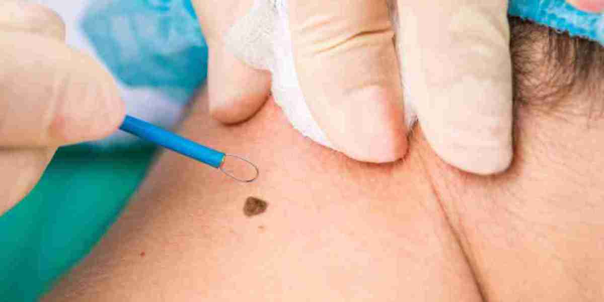 Warts Removal Surgery: A Guide for Parents