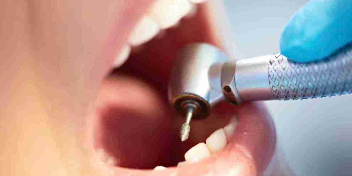 How Strong Are Composite Fillings Compared to Metal?